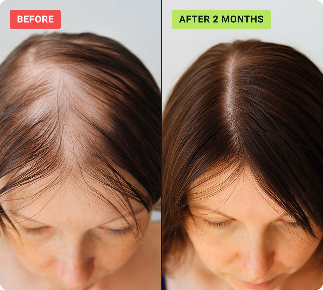 Hair density before and after